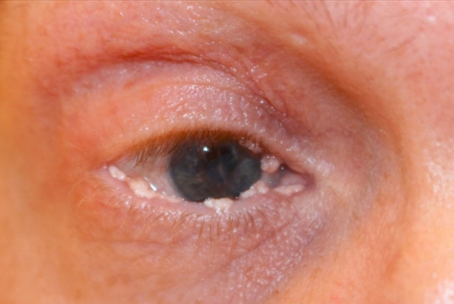 Ligneous Conjunctivitis